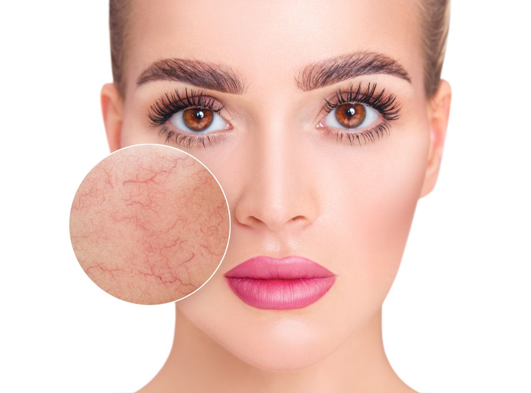 IPL Hautverjüngung Sabina Decavele Living Beauty