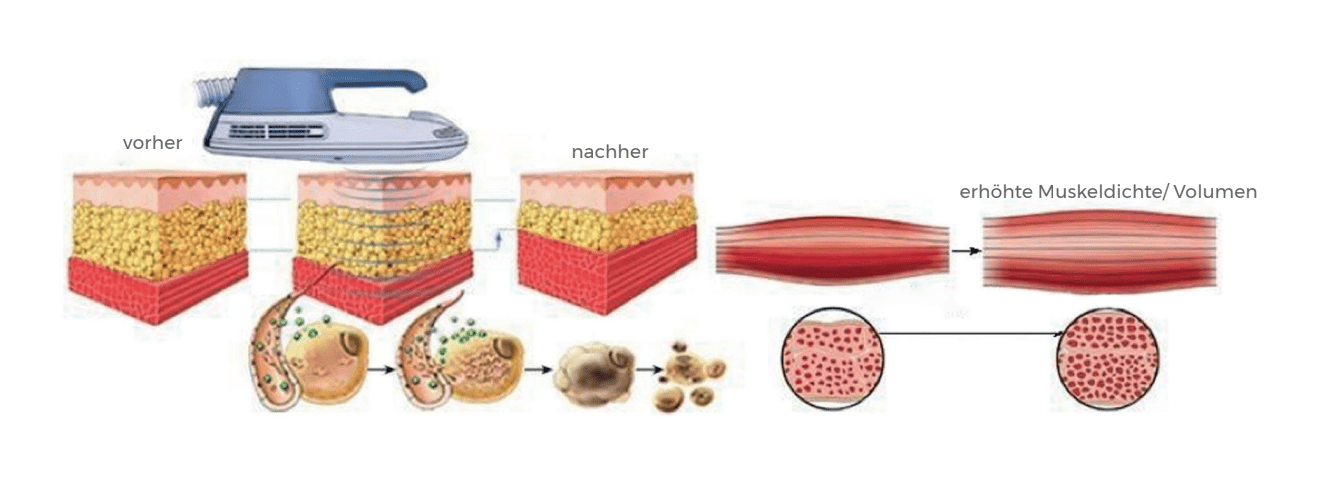 Living-Beauty-Sabina-Decavele-Rf-Sculpting-Muskeln
