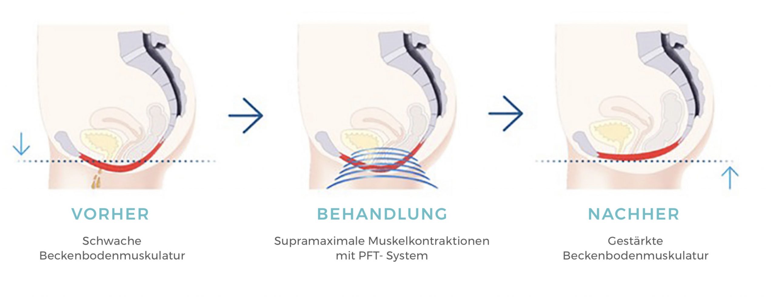 PelvicChair-Vorher-nachher